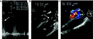Pre-correction. (A) Continuous Doppler of the RVOTF with peak and mean gradient of 66mmHg and 29mmHg, respectively, in a deep trans-gastric of the right ventricle (Deep TG RV). The arrow indicated the peak gradient (B). Long axis of the aortic valve in the mid-esophagus (ME AV LAX) showing the classical characteristics of the TOF; overriding aorta and broad VSD. The arrow points the VSD. (C) Color Doppler interrogation of the previous view, showing right to left shunting trhough the VSD, the arrow points the flow. LA, left atrium; LV, left ventricle; RV, right ventricle; AO, aorta.