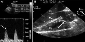 Corrected. (A) Continuous Doppler of the RVOT with peak and mean gradients of 30 and 11mmHg in a deep trans-gastric of the right ventricle (Deep TG RV). The arrow indicates the peak gradient (B). Long axis of the aortic valve in the mid-esophagus (ME AV LAX) indicating the correction of the aorta aligned to the right with the patch. The arrow indicated the patch. LA, left atrium; LV, left ventricle, RV, right ventricle, AO, aorta.