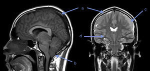 Brain MRI. (a) Diffuse dural thickening, (b) herniation of the cerebellar amygdalae, (c) bilateral fronto-temporal subdural collections, (d) diffuse cerebral edema.