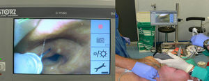 C-MAC d-Blade videolaryngoscopy of the patient indicating a C-L grade 1. Laryngotracheal topical anesthesia is administered through an epidural catheter according to the SAYGO technique, and is then followed by OTI.