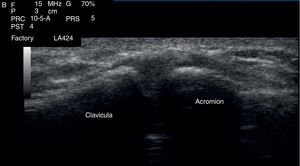 After a disinfection with chlorhexidine, 2mL were infiltrated in the acromioclavicular joint.