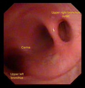 Anatomical variation: tracheal bronchus. The right bronchus emerges superior to the bifurcation of the carina. Congenital anomaly present in 0.33% of the population.
