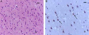 Cortex section of a rat in the COMPSEVOFLURANE group. (A) HE staining. Extensive neuronal death foci can be seen (arrows). Bar scale 25μm. (B) Immunohistochemistry for Caspase-3. Necrotic neurons and mild positive marker response (arrows). Bar scale 15μm.