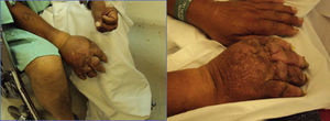 Limb appearance three years after the initial trauma, and one week after the neurostimulation trial.