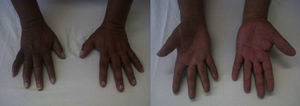 Appearance of the hands one month after definitive placement of the neurostimulator.