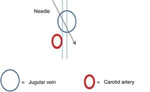 Change in needle direction (black arrow). The goal is to avoid the lateral arterial wall in order to lower the probability of vascular injury.