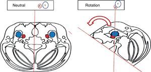 Effect of cephalad rotation on vascular overlap.