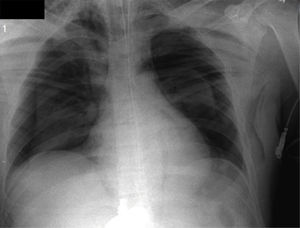 Chest X-ray with spontaneous bilateral pneumothorax
