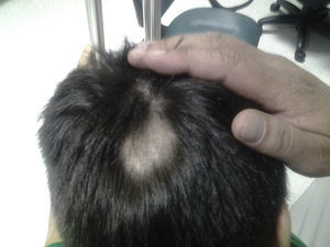 Zone of alopecia 4 weeks after surgery. Signs of regrowth.