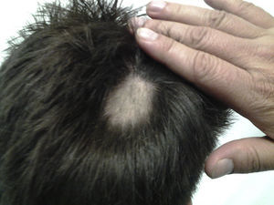 Zone of alopecia 12 weeks after surgery. Signs of hair regrowth and reduction of the size of the area.