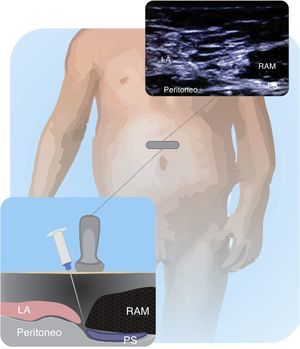Structures identified when performing a rectus sheath block. The posterior sheath (PS) is the target site to deposit the local anesthetic agent. Rectus abdominis muscle (RAM); linea alba (LA).