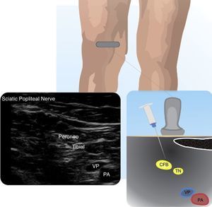 Sciatic popliteal nerve (SPN). Depicts the SPN at the insertion of its two components: tibial nerve (TN) and common fibular nerve (CFB). popliteal artery (PA).