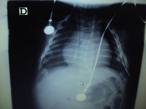 Postoperative chest radiograph showing expansion of the right lung.