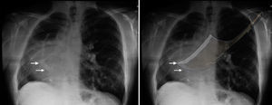 The scimitar sign in the pulmonary radiograph.