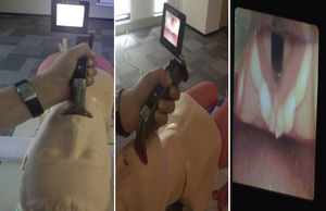 Storz videolaryngoscope: insertion and view of the vocal chords