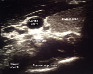 Is the ultrasound image where the carotid artery is observed at a higher level, this medial thyroid; below the carotid artery are the long Colli muscle and the lower part the transverse process of C6 which is recognized by its former tuber identified.