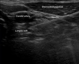 Is an ultrasound image, the approximation plane where the needle path heading medially over the longus colli muscle.