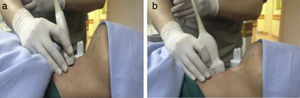 Axial or short-axis approach (A) and longitudinal or long axis approach (B).