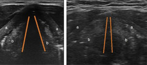 Cross-section of the glottis. (A) Open glottis, a: thyroid cartilage; b: vocal cords. (B) Closed glottis.