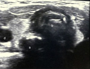 The axial view depicts two circular structures with air artifacts, the trachea (b) and the esophagus (a), consistent with esophageal intubation. Part of the thyroid gland (c) and the left carotid artery (d) are also visible.