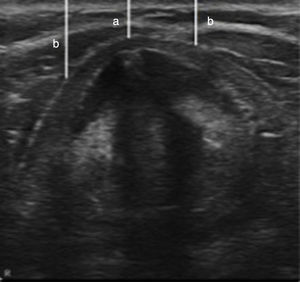 The soft tissue measurement is done through the axial thyroid window, averaging the distance from the skin to the airway along the midline (a), and 15mm to the left and right sides (b).