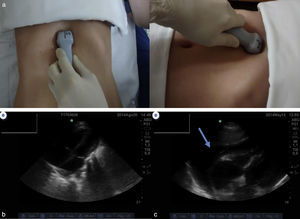 (a) Appropriate positioning of the transducer for the subxifoid window (low-frequency sectorial transducer). (b) Normal subxifoid view. (c) Cardiac taponade, pericardiac fluid and collapsed right ventricle.