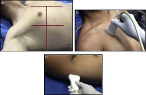 (a) Ultrasound examination of the lung by regions – International Liaison Committee on Lung Ultrasound (ILC-LUS) for the International Consensus Conference on Lung Ultrasound.17 (b, c) The transducer should be perpendicular to the ribs as illustrated. The projection obtained in b is usually recommended for the evaluation of pleural movement and c is ideal to identify the presence of pleural fluid.