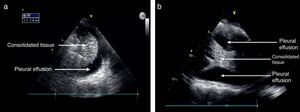 (a) Pleural effusion and consolidated lung tissue. (b) Pleural effusion and area of consolidation with a few membranes.