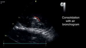 Basal consolidation area with visible hyperechogenic area during the examination. In red the air bronchogram path.