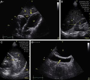 View of the 4 Ps of FAST. A, Pericardial in the subxiphoid 4 chamber window. Observe that there is no fluid between H, the anterior blade of the pericardium (arrow) and the right ventricle. B, Perihepatic in the upper right quadrant of the abdomen. Observe the Morrison pouch (arrow) between H and R with an absence of fluid. C, Perisplenic in the upper left quandrant of the abdomen. Observe the absence of fluid (arrow) between B and R. Also observe the normal reflection of the spleen above the diaphragm (RB). D, Pelvic. Observe the most anterior hypoechoic image that corresponds to the bladder (V) and the more posterior free fluid (arrow). VI: left ventricle, VD: right ventricle, H: liver, D: diaphragm, B: spleen, R: kidney.