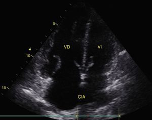 Apical 4-chamber window. The relationship between the VD and the VI should not be greater than 66%. Note how the VD is larger than the VI. CIA: Atrial Septal Defect.