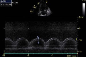 Apical 4-chamber window in M-mode. Tricuspid annular plane systolic excursion (TAPSE) (blue line). Normal value greater than 1.5cm.