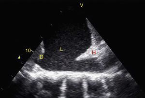 Upper left quadrant of EFAST. Observe a hypoechoic zone in the supradiaphragmatic zone that indicates the presence of liquid (L) and the hepatization of the lung, giving it the appearance of a solid organ (H). D: Diaphragm.