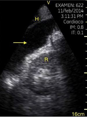 Upper right quadrant in FAST. Observe the hypoechoic image (arrow) that separates the kidney (R) from the liver. This is compatible with intra-abdominal free fluid.