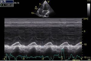 Apical 4-chamber window in M-mode. Mitral annular plane systolic excursion or MAPSE (blue line 1.42cm). Normal value greater than 1cm.