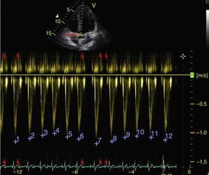 Apical 5-chamber window. Pulsed Doppler in the left ventricle outflow tract (LVOT) (red arrow). Variability of maximum velocity of the systolic volume in the LVOT (blue numbers) greater than 12% is related to volume responsiveness.