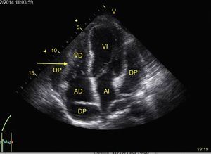 Apical 4-chamber window showing cardiac tamponade. Observe the severe pericardial effusion (DP) and the compression on the right chambers (arrows). VD: Right Ventricle, VI: Left Ventricle, AD: Right Atrium, AI: Left Atrium.