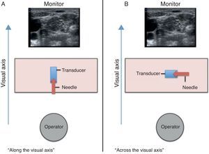 (A) (along the visual axis) and (B) (across the visual axis): monitor, transducer, needle and operator orientation in relation to the visual axis.