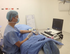 Position for performing the sciatic popliteal nerve block. Patient in prone position with the lower limbs in neutral position. The anaesthetist is positioned on the opposite side of the block, with the monitor in front, aligned along the visual axis. Ergonomic position with no inadequate wrist, neck, shoulder or trunk posture. Volar grasp of the transducer with support for the hand. In-plane needle insertion with along-the-visual-axis approach.