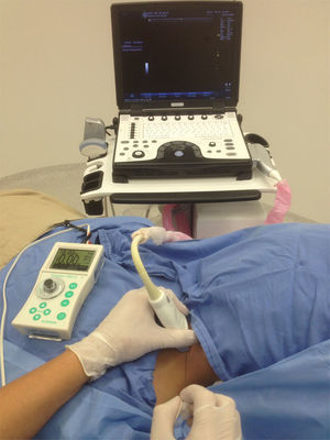Position for performing interscalene and supraclavicular nerve blocks. Patient in supine position at 45 degrees, arm in adduction, head slightly rotated to the contralateral side. Monitor in front, aligned along the visual axis. Volar grasp of the high-frequency linear probe, using the patient as support for the hand. In-plane needle entry with along-the-visual-axis approach.