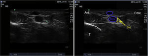 Ultrasound imaging of the saphenous nerve. SN: saphenous nerve; GSV: greater saphenous vein; T: tibia.
