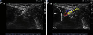 Ultrasound imaging of the tibial nerve. PTN: posterior tibial nerve; PTA: posterior tibial artery; MM: medial malleolus; FHLT: flexor hallucis longus tendon.