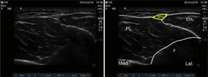 Ultrasound imaging of the superficial peroneal nerve. SPN: superficial peroneal nerve; EDL: extensor digitorum longus; PL: peroneus longus; F: fibula.
