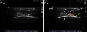 Ultrasound imaging of the deep peroneal nerve. DPN: deep peroneal nerve; ATA: anterior tibial artery; EDL: extensor digitorum longus; T: tibia.