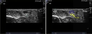 Ultrasound imaging of the sural nerve. SN: sural nerve; LSV: lesser saphenous vein; F: fibula; PS: peroneal sheath.