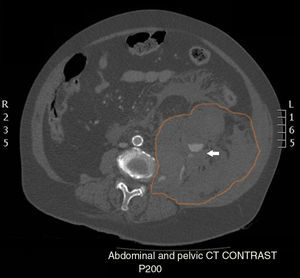 Left retroperitoneal haematoma extending from the anterior and posterior para-renal space to the perisplenic space and the pelvis, with displaced adjacent structures. Presence of free fluid throughout the abdominal cavity. Most of the contour of the retroperitoneal haematoma is outlined in orange. Presence of active bleeding from the lumbar artery marked by the white arrow.