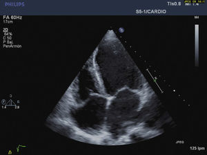 Preoperative transthoracic echo. Ejection fraction of 20%.