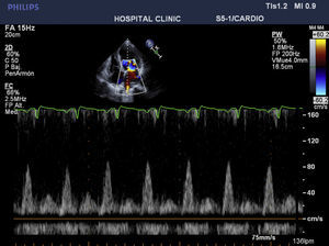 Preoperative echo showing E-wave/A-wave ratio of 8cm/s.