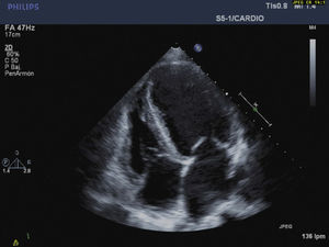 Transthoracic echo 2 months after surgery. Ejection fraction of 42%.