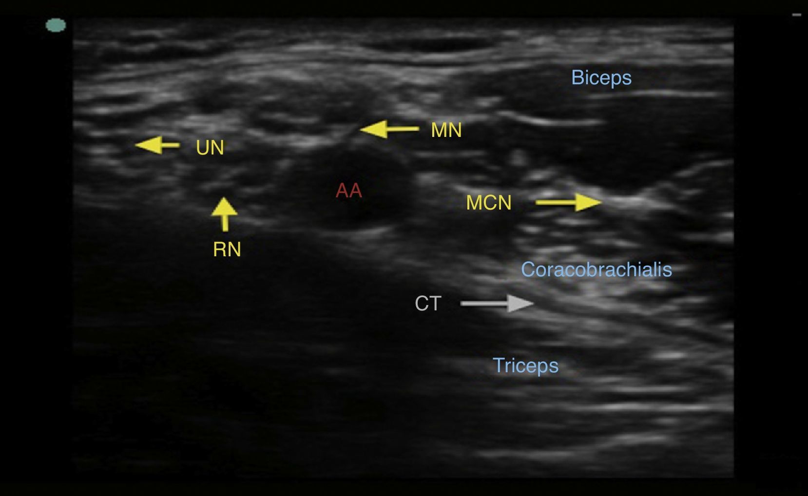 Ultrasound and nerve stimulation-guided axillary block | Colombian ...